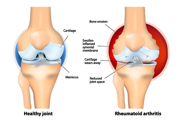 Rheumatoid Arthritis