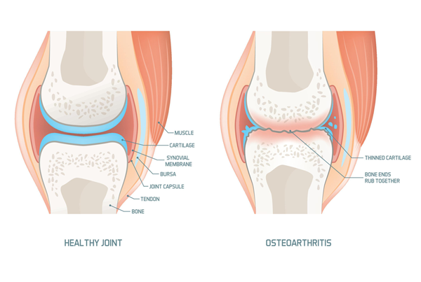 Osteoarthritis