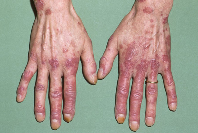 Systemic Lupus Erythematosus