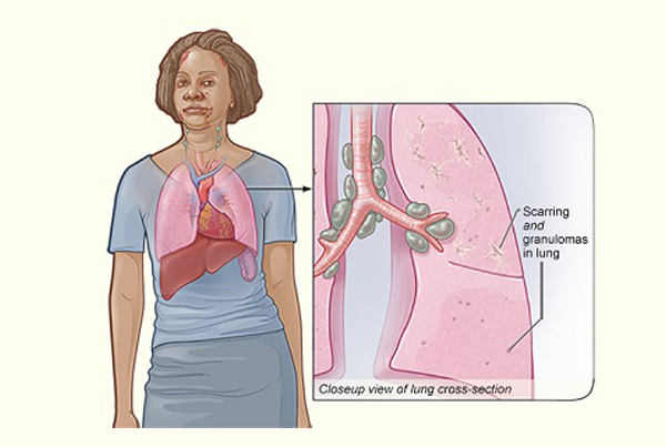 Sarcoidosis