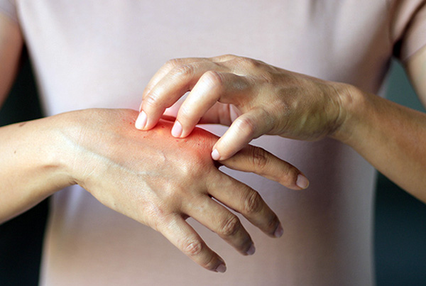 Reactive Arthritis Treatment