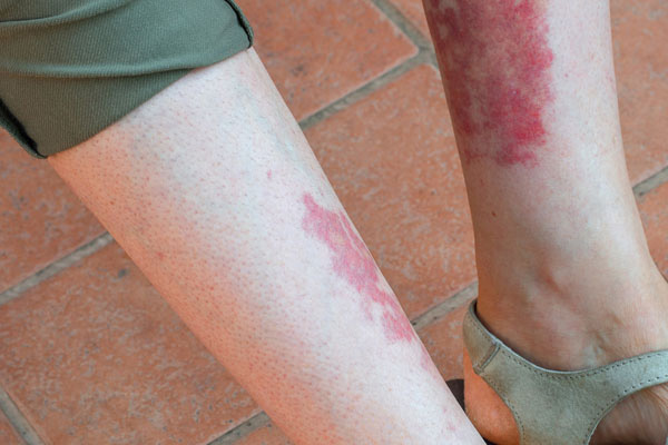 Vasculitis Treatment